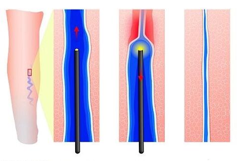 Koagulacja laserowa