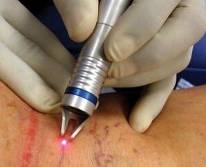 Jak przeprowadzane jest laserowe leczenie żylaków