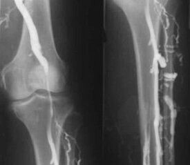 Możliwości diagnostyczne żylaków kończyn