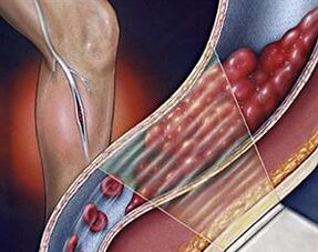 żylaki żył głębokich kończyn dolnych